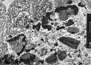 M,66y. | follicular cyst with hyaline Rushton bodies M,66y. | follicular cyst with hyaline Rushton bodies
